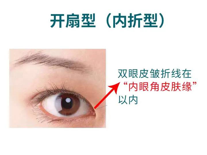 平行双眼皮改扇形双眼皮不是那么简单的，难点和这四点有关。