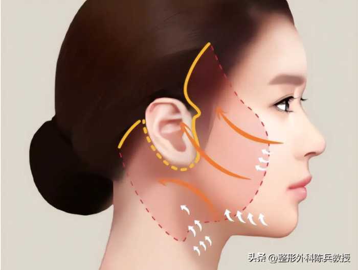 广州拉皮丨医生解答您关于面部微创提升的所有问题