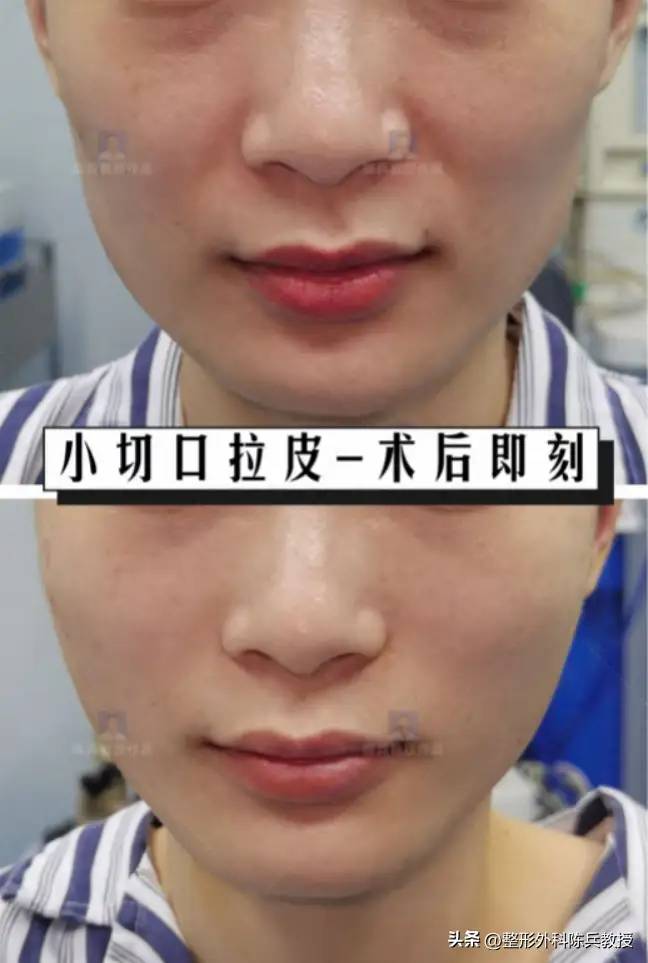 广州拉皮丨医生解答您关于面部微创提升的所有问题
